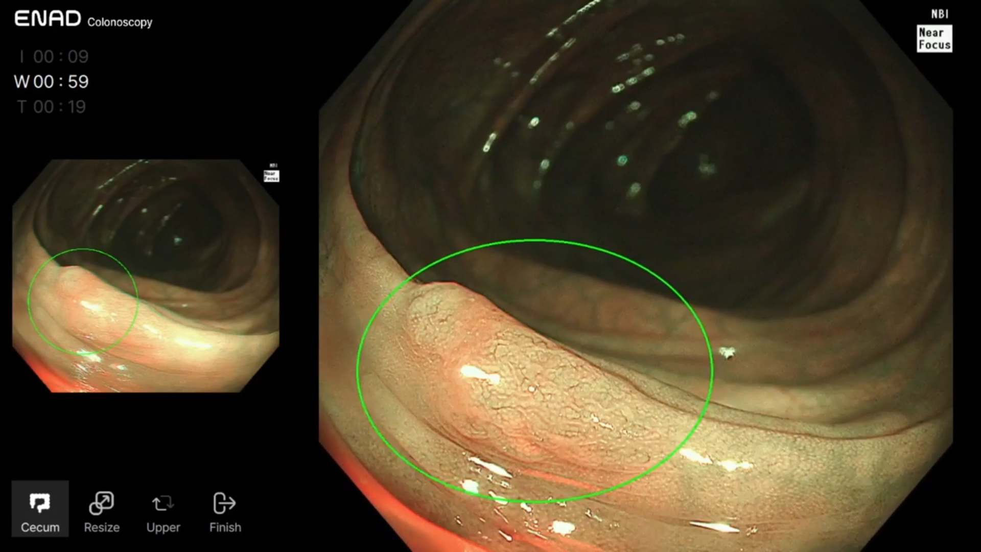 Real-time AI colonoscopy detection