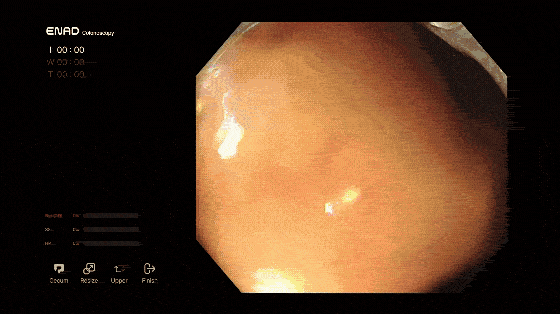 ENAD automatically recognizes withdrawal time measurment when the cecum is reached