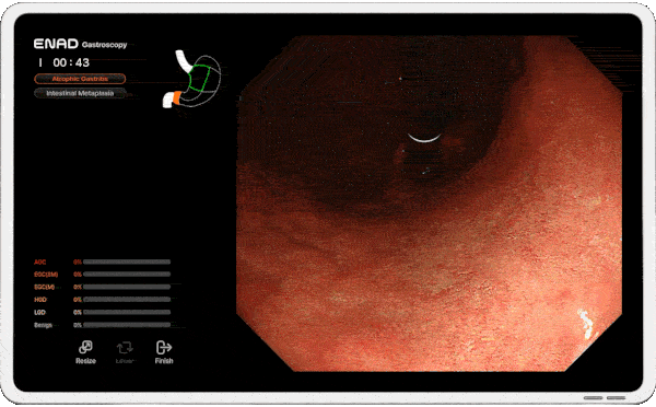 Real-time Diagnosis AI gastroscopy ENAD