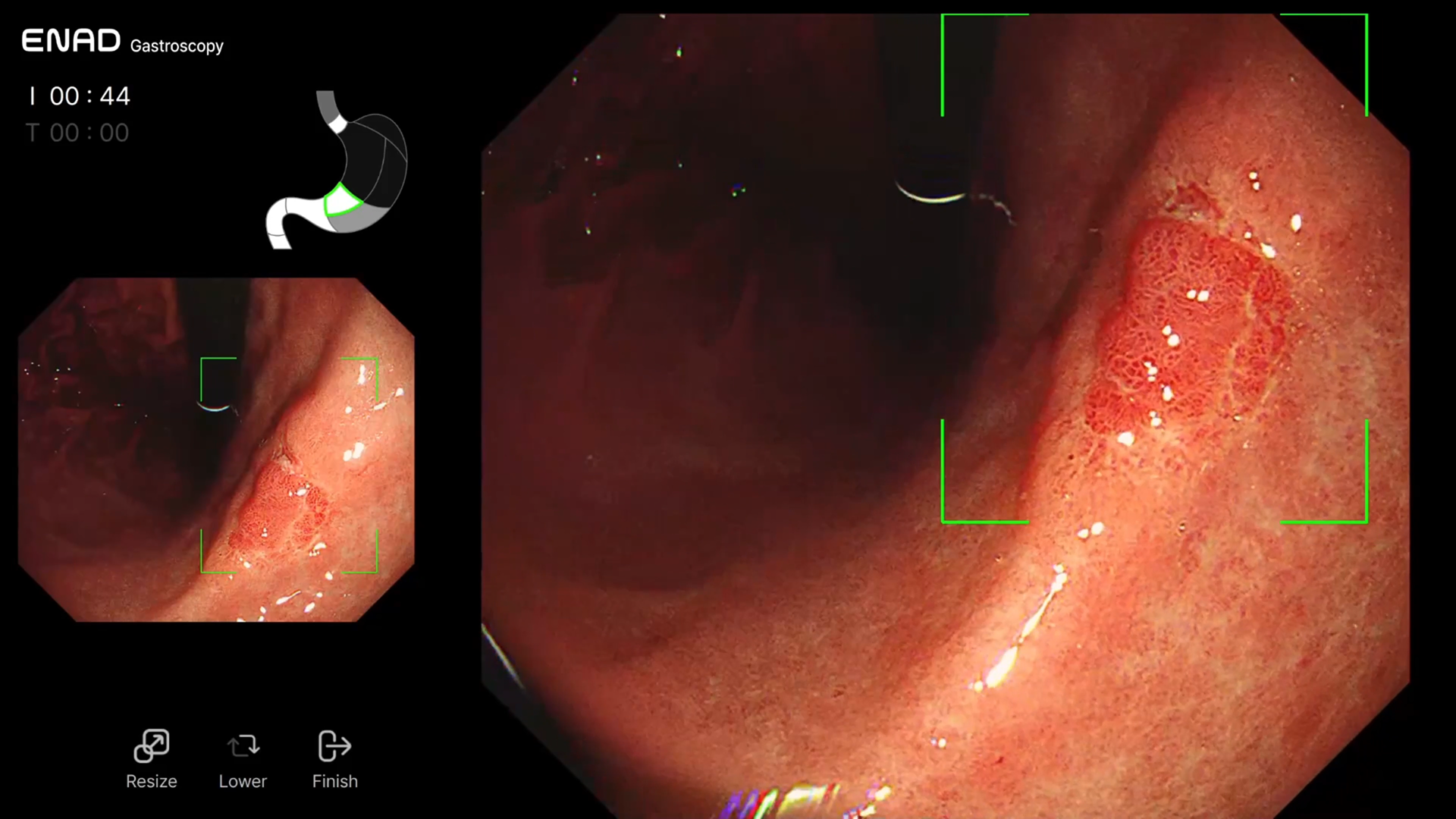 Adenoma detection AI gastroscopy