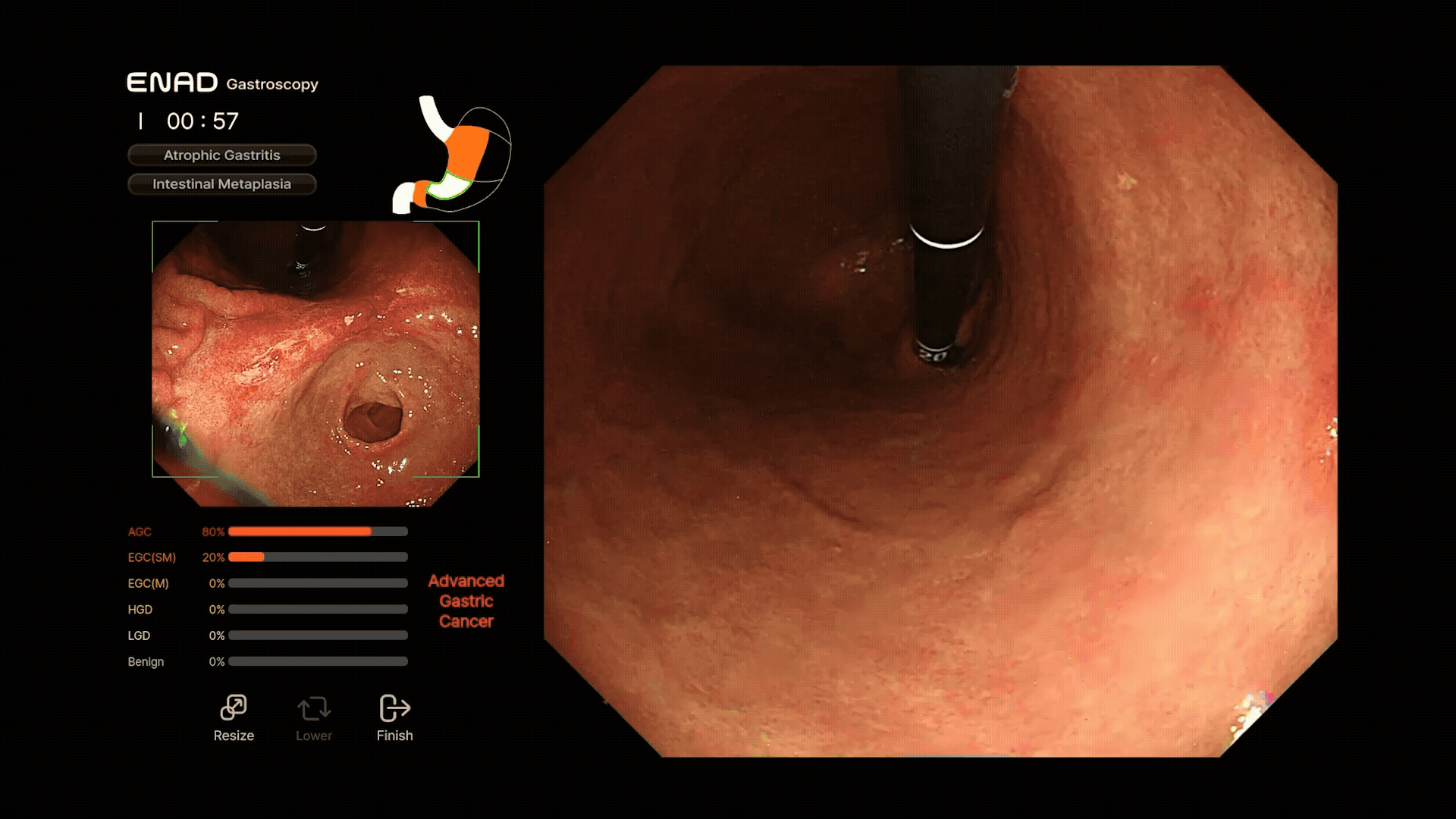 Real-time diagnosis AI gastroscopy CAD-Gx